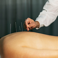 A-woman-lays-down-receiving-acupuncture