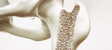 A cross section of the hip bone shows its density loss. 
