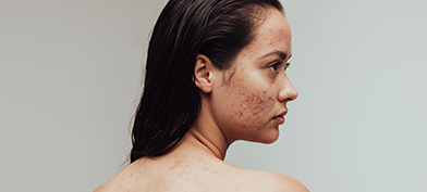 A-woman-stares-to-side-bare-back-showing