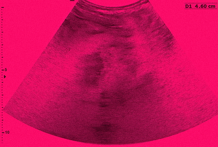 A sonogram from an ultrasound shows the uterus without a fetus.