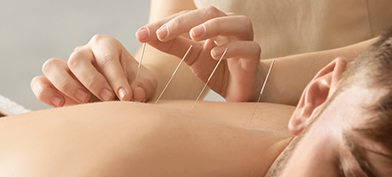 Acupuncture is performed on the back of a man.