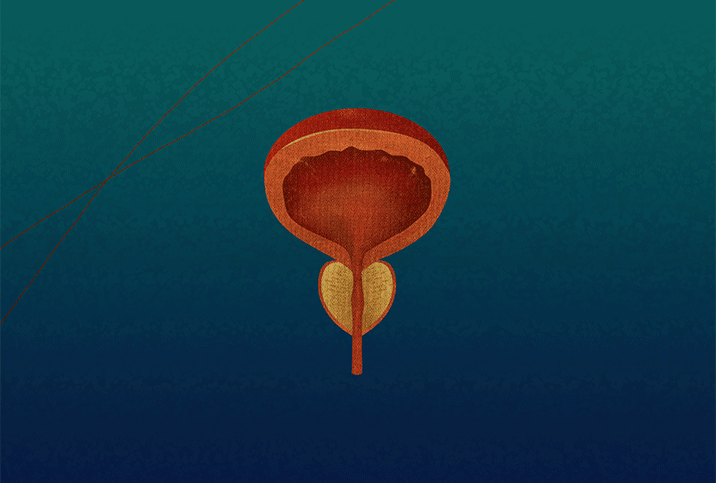 An orange prostate turns grey on top of a blue and green gradient background.