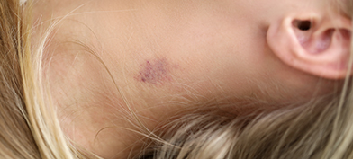 A blonde woman lays down with a hickey on her neck.