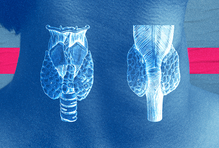 An outline of a normal thyroid sits next to one with a thyroid disorder inside the neck of a person.