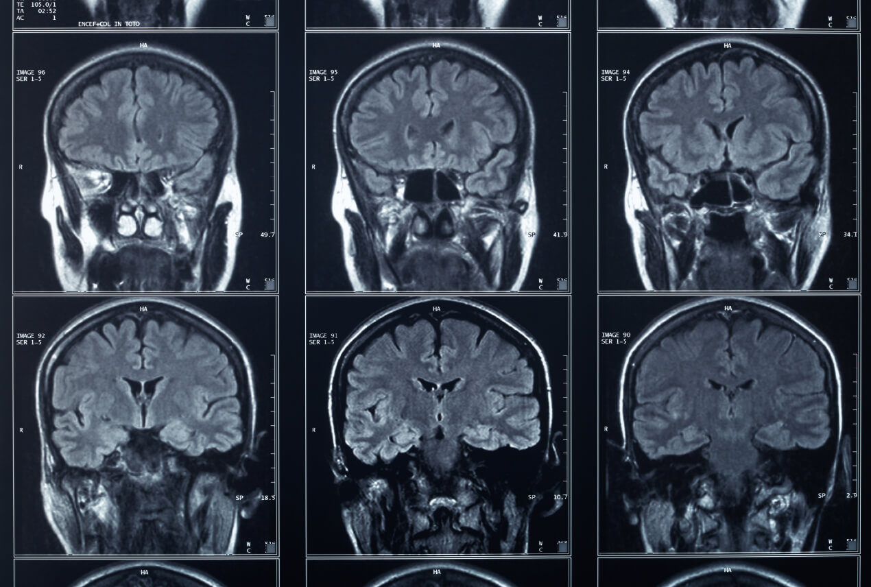 An x-ray of a brain scan shows the progression of Alzheimers Disease.