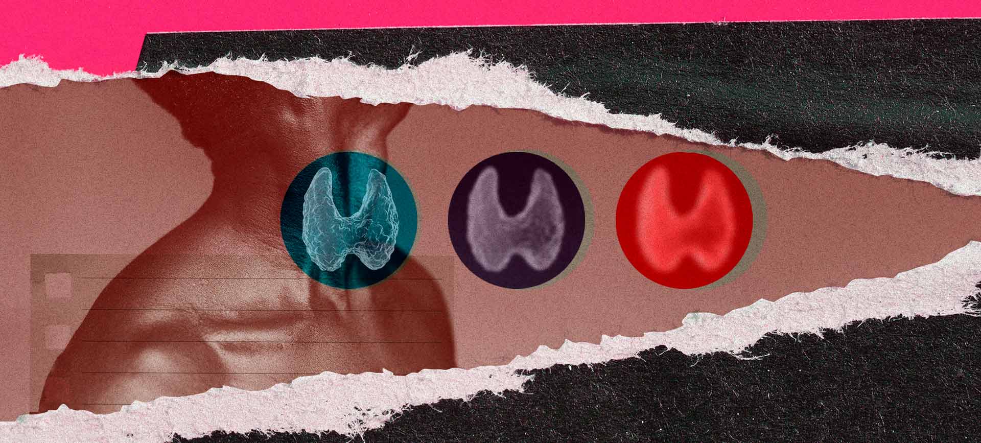 A torn page reveals a man standing with three different colors of thyroids along his neck.