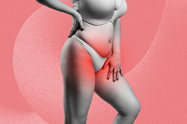 The lower half of a woman posed in underwear has redness around her pelvic region.