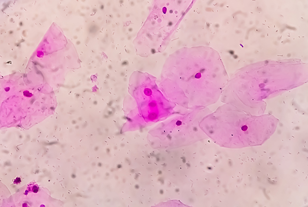 Bacterial Vaginosis