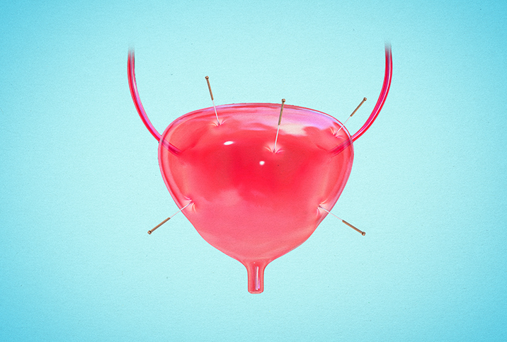 A bright red bladder has acupuncture needles poking into it.
