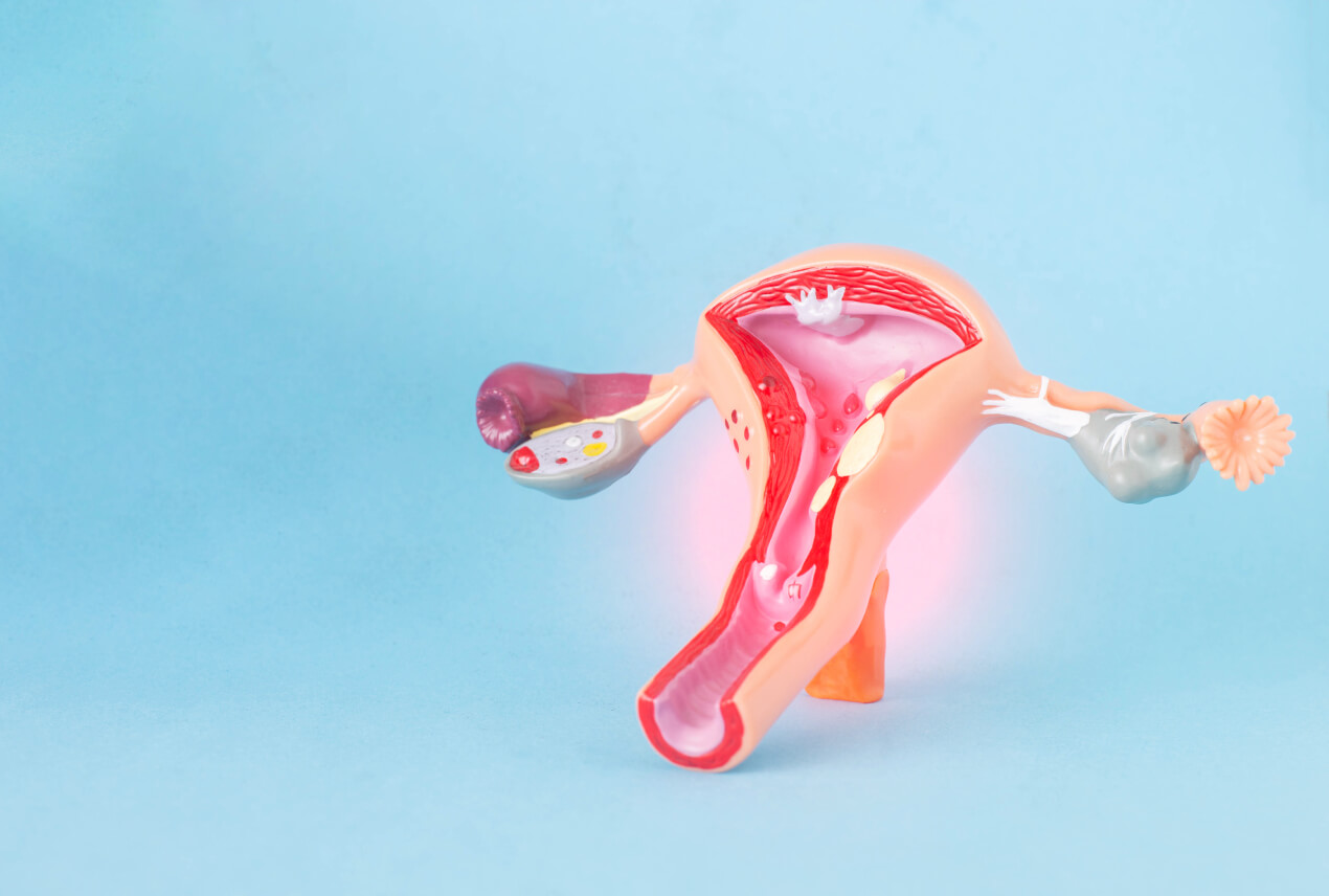 fibroids