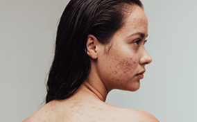 A-woman-stares-to-side-bare-back-showing