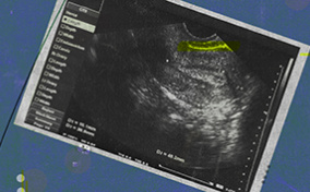 An endometrial stripe is highlighted in yellow on an ultrasound photograph.